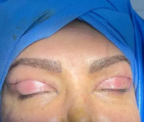 بلفاروپلاستی (جراحی زیبایی پلک ) اقساطی در شیراز، خلیلی، خ قصرالدشت