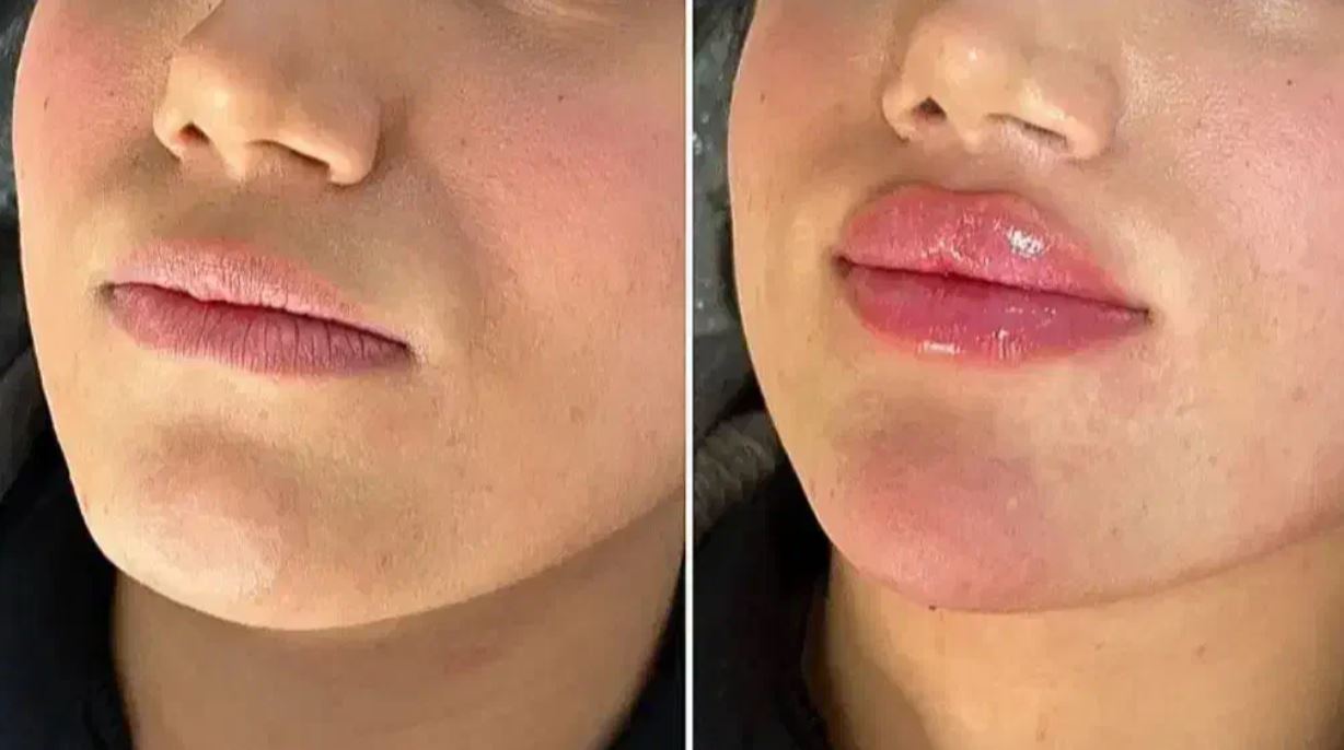 تخفیف ویژه ژل و بوتاکس به مناسبت روز شیراز واقع خیابان صاحب الامری - خانم ها