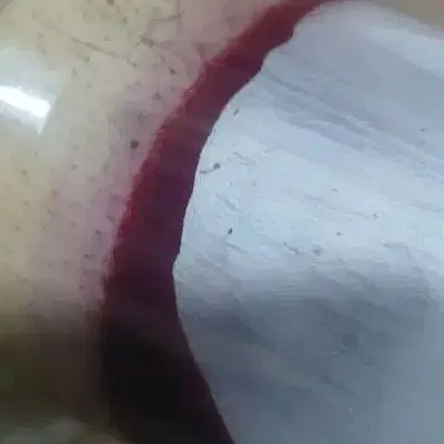 حجامت وبرداشت انواع خال و زیگیل توسط پزشک متخصص در شیراز، شهرک نیروی انتظامی، خ تخت جمشید دهم