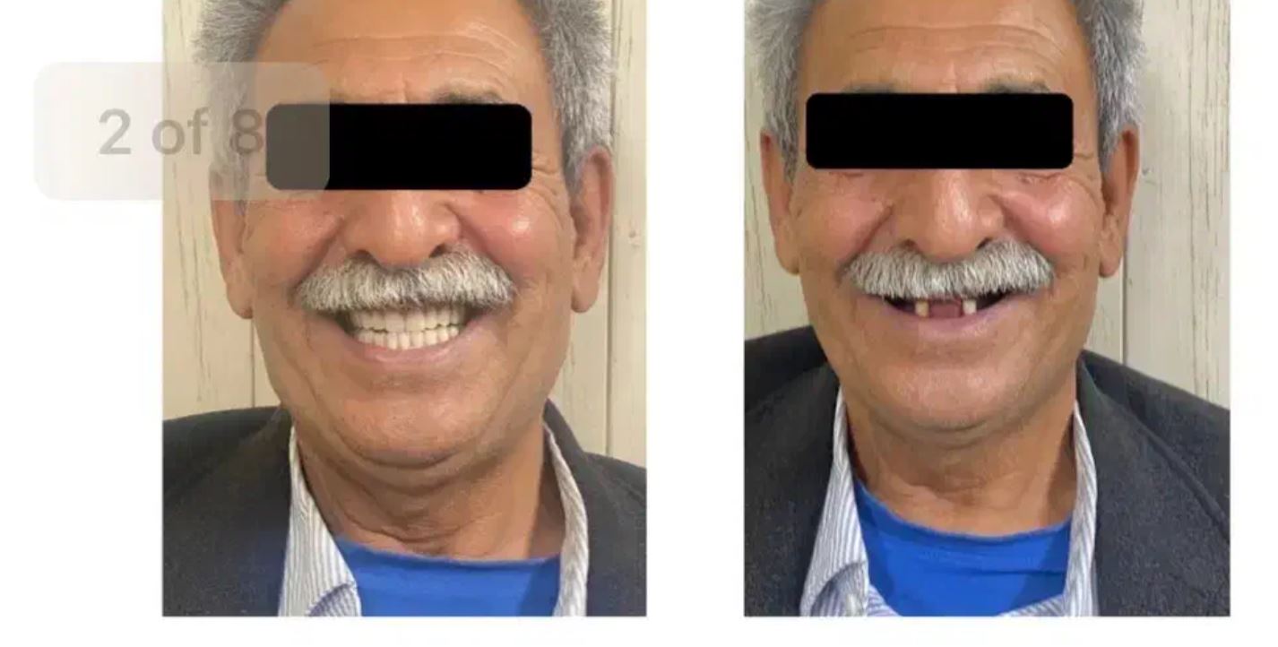 داندانپزشکی، دندانسازی،اوردنچر در شیراز - آقایان