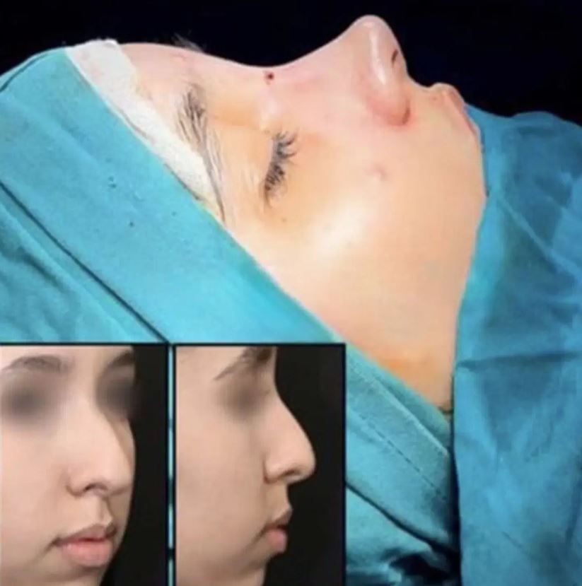 شرایط اقساط عمل بینی 12 ماهه با شرایط سفته در سینما سعدی شیراز