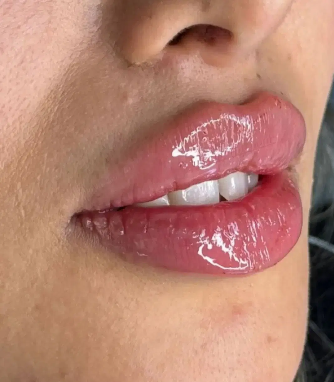 مزو ژل فیلر و بوتاکس 950گونه فولفیس زاویه لب واکسن در شیراز، سینما سعدی