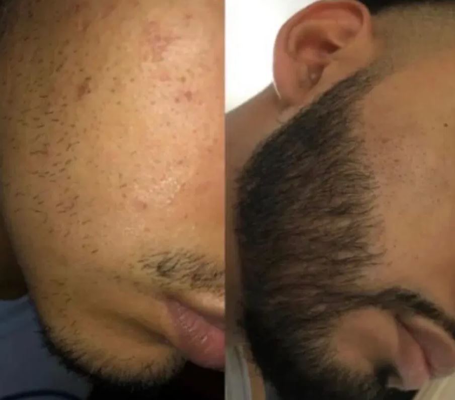 هنوز ریش نداری - درمان پوست و مو در خیابان سوخکیان داراب