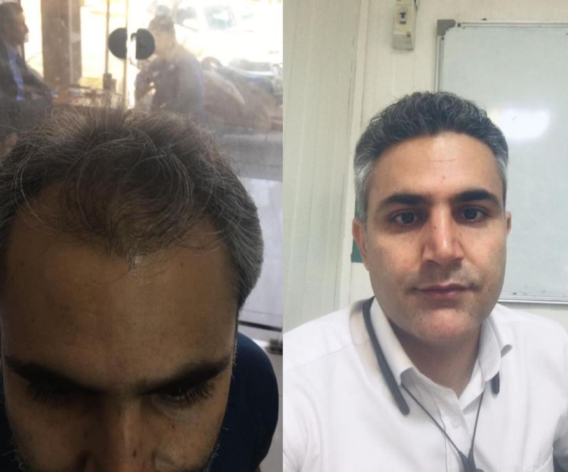 کاشت مو ، ابرو و ریش در شیراز
