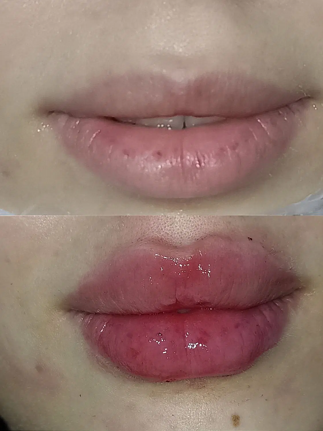 اف خدمات تزریق ژل و پی آر پی و مزو در صدرا-فارس، فاز ۱