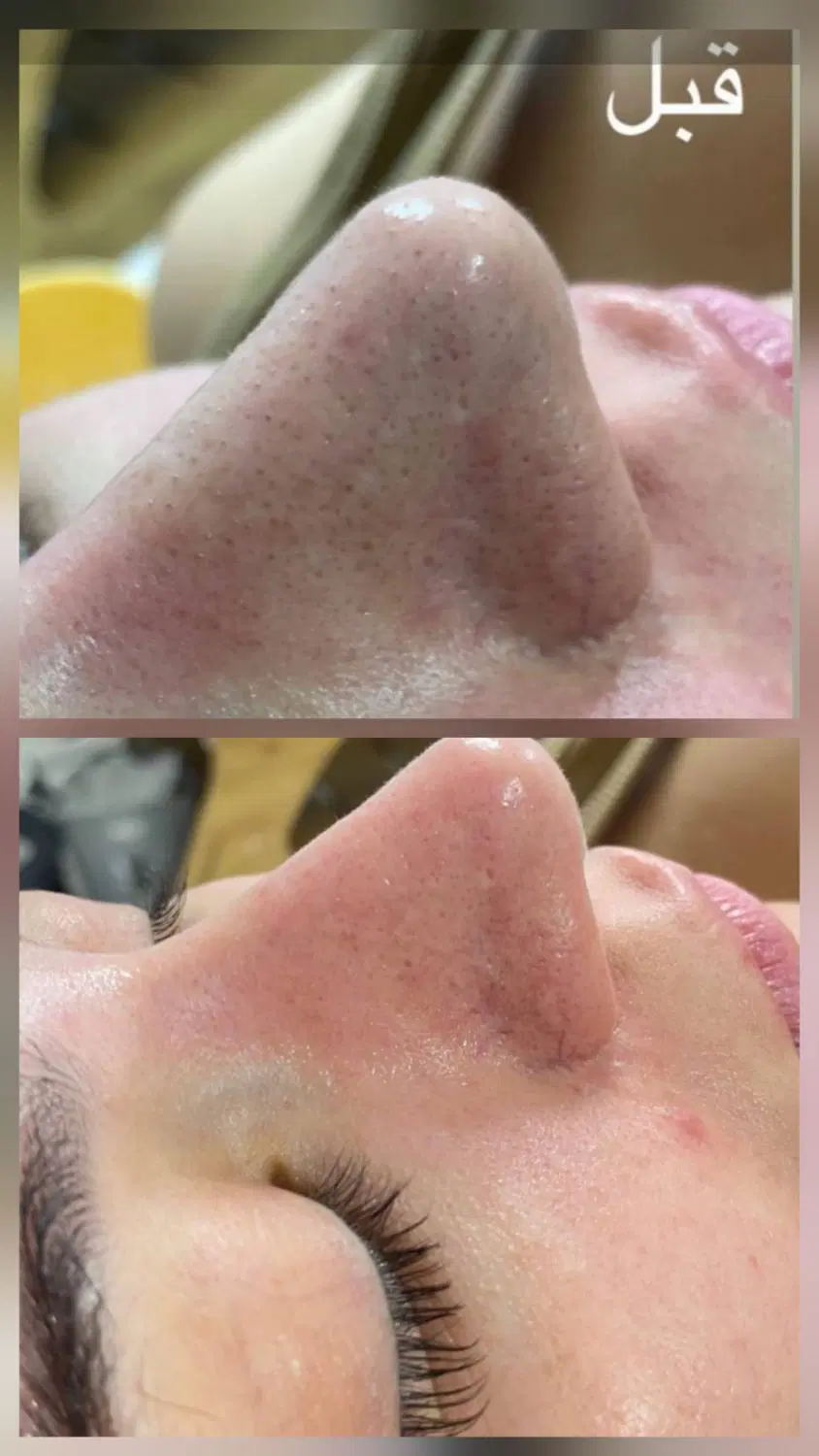 فیشیال پاکسازی صورت در کازرون، خ 933