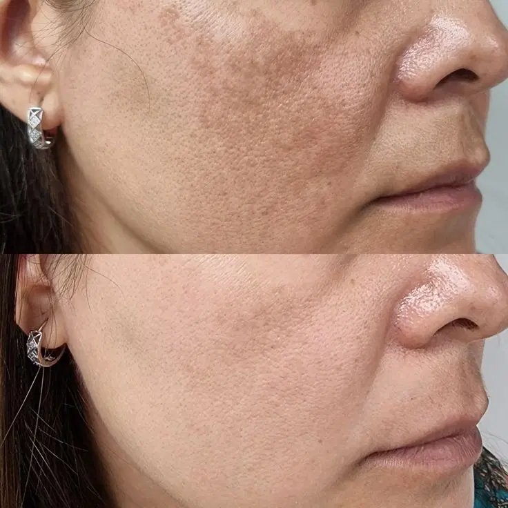 لایه برداری لک و پاکسازی تخصصی پوست با تخفیف ویژه در مرودشت، بیست متری بیمارستان، خ شهید محمد مرادی