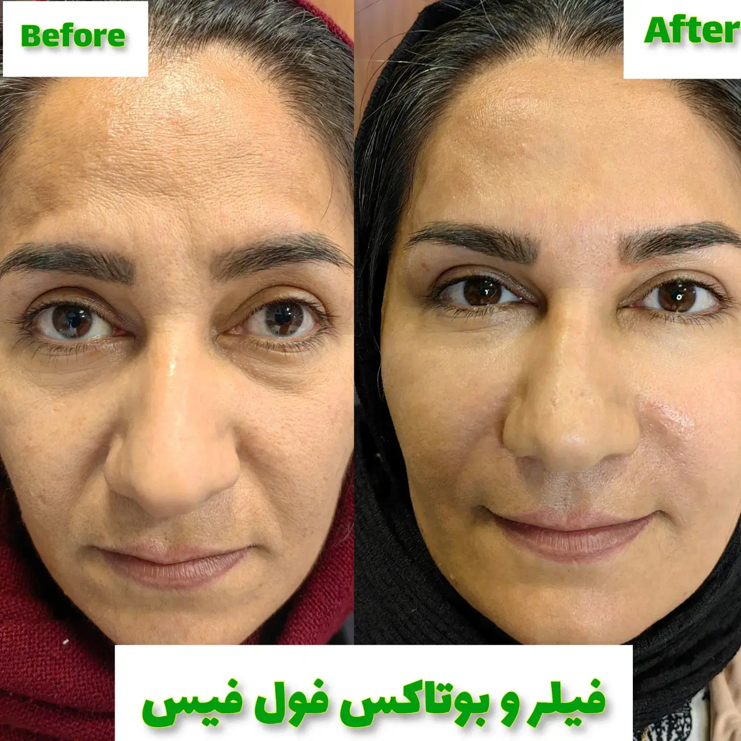 تزریق انواع بوتاکس ژل آنزیم مزو پی آرپی، نخ لیفت در صدرا-فارس، فاز ۱، بلوار پاسداران