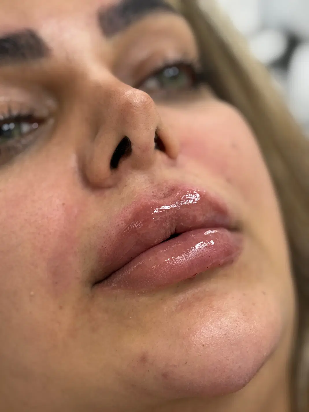 تخفیفات مزوژل،بوتاکس،ژل،فیلرتزریق پزشک واموزش در شیراز، قدوسی غربی
