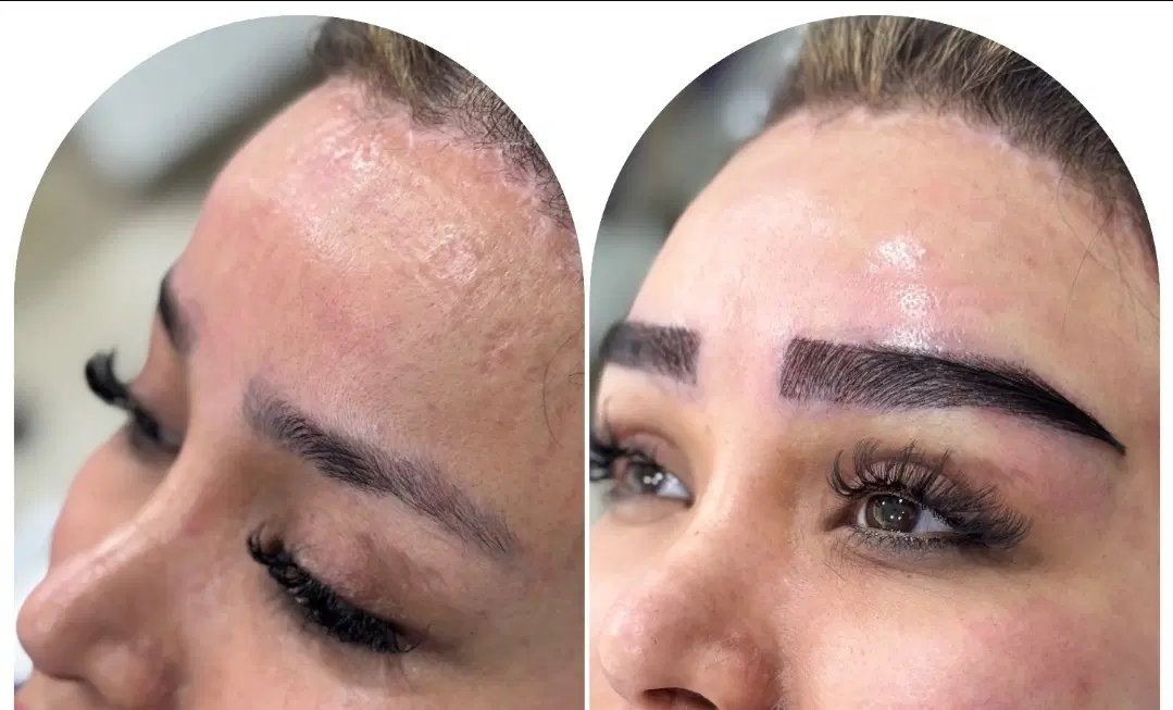 کاشت ابرو دائم در کلینیک پوست و مو در لار، خ کارمندان