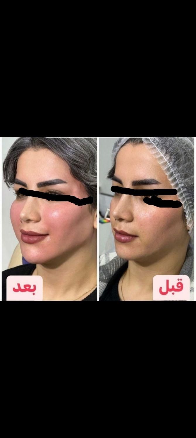 آموزش فوق تخصصی ژل وبوتاکس در شیراز، معالی‌آباد