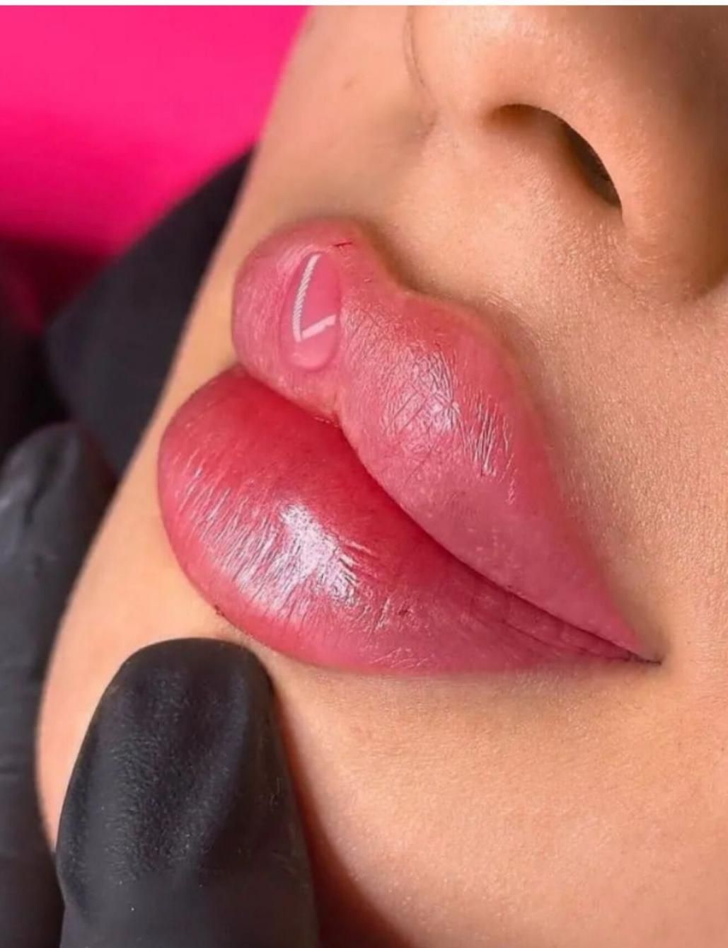 آموزش و تزریق ژل و بوتاکس سی سی 1 تومن در شیراز، دارالرحمه