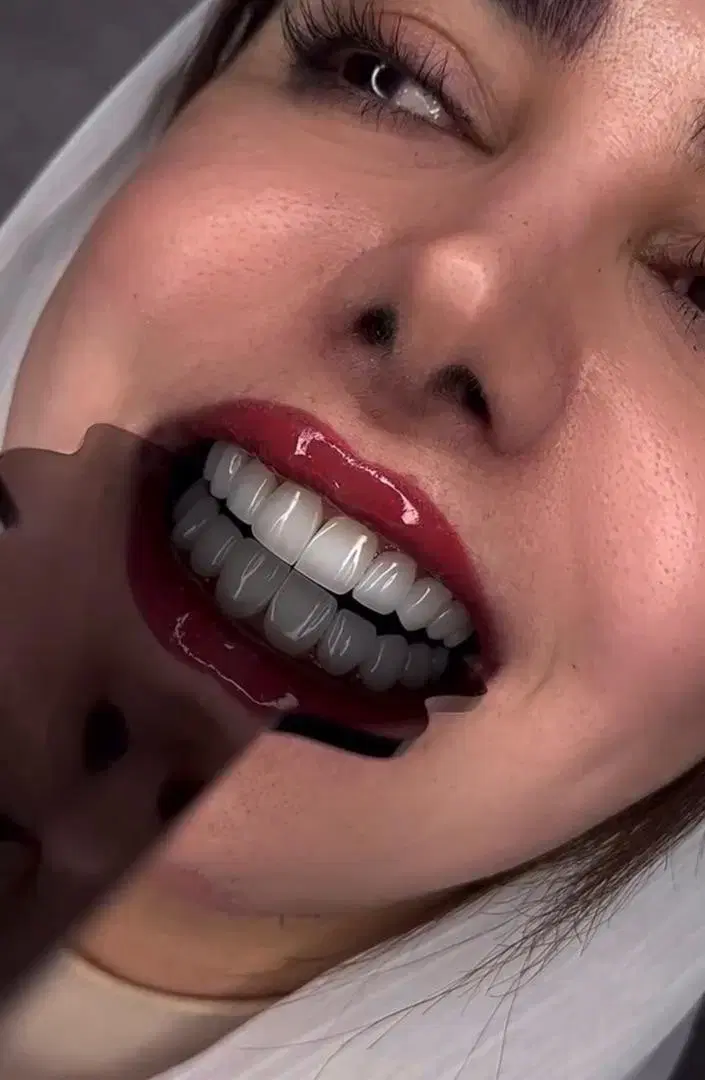 تخفیف ویژه کامپوزیت دندان در شیراز، قصرالدشت، خ قصرالدشت