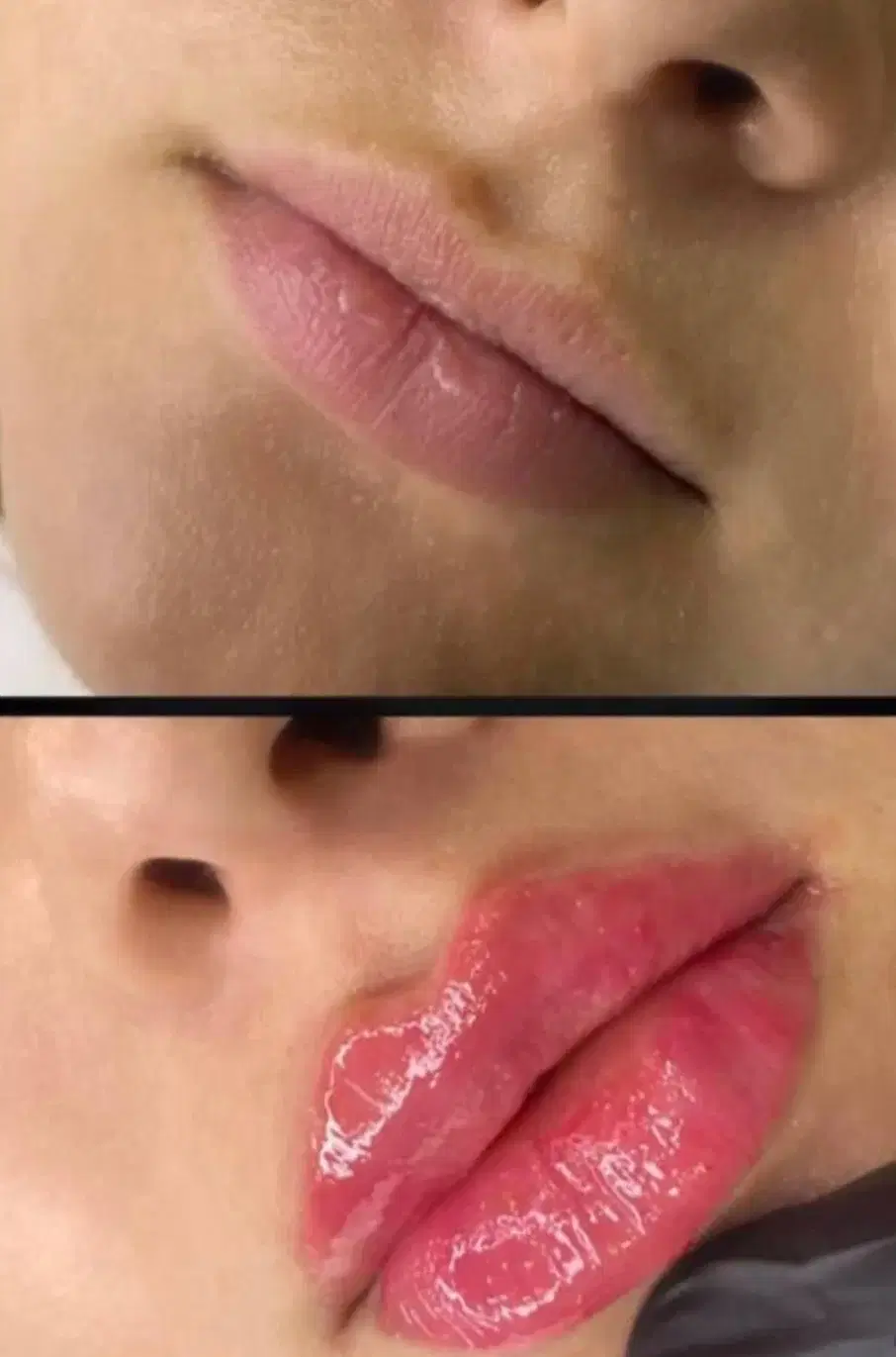 تزریق و آموزش ژل و بوتاکس و مزو وپرسینگ و غیره در شیراز، نصر، خ بهاران