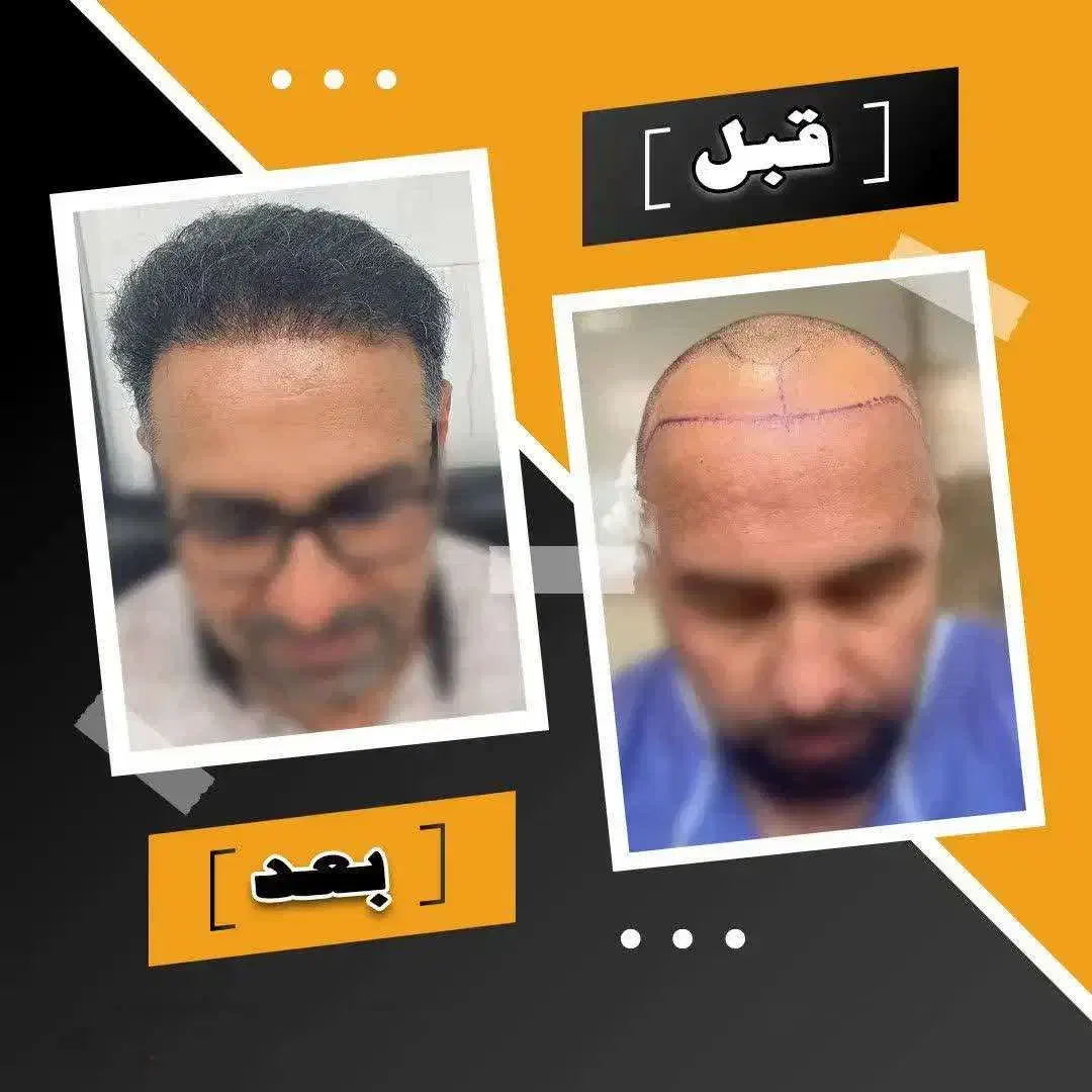 تنها مرکز تخصصی کاشت مو و ابرو + شرایط ویژه اقساط در شیراز، معالی‌آباد، بلوار دکتر شریعتی