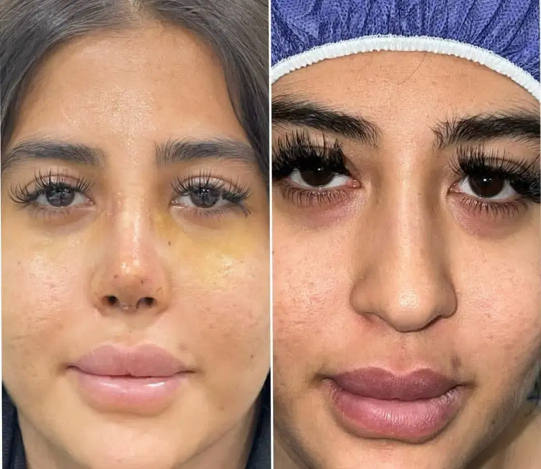 عمل بینی فقط ۶۵ میلیون،بهترین متخصص شیراز،اقساطی در مرودشت، ژیان