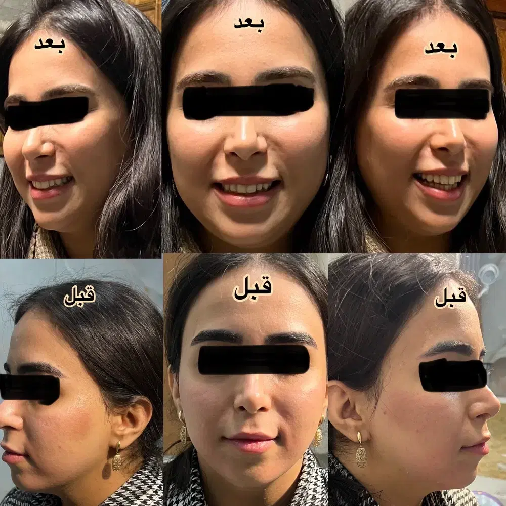 ژل نخ لیفت مزوژل(توسط پزشک)۲۰ درصد تخفیف در شیراز، نشاط، خ نشاط