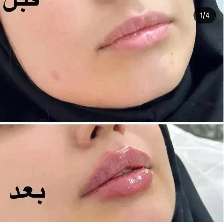 ژل فیلر بوتاکس شیراز خ صاحب الامری