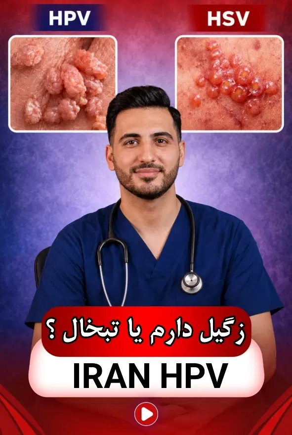 اگه میخوای زگیل رو برای همیشه از بین ببری در شیراز، عفیف‌آباد، خ عفیف آباد ششم