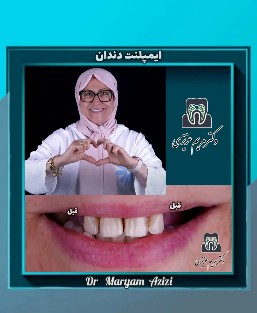 ایمپلنت دندان شیراز ملاصدرا