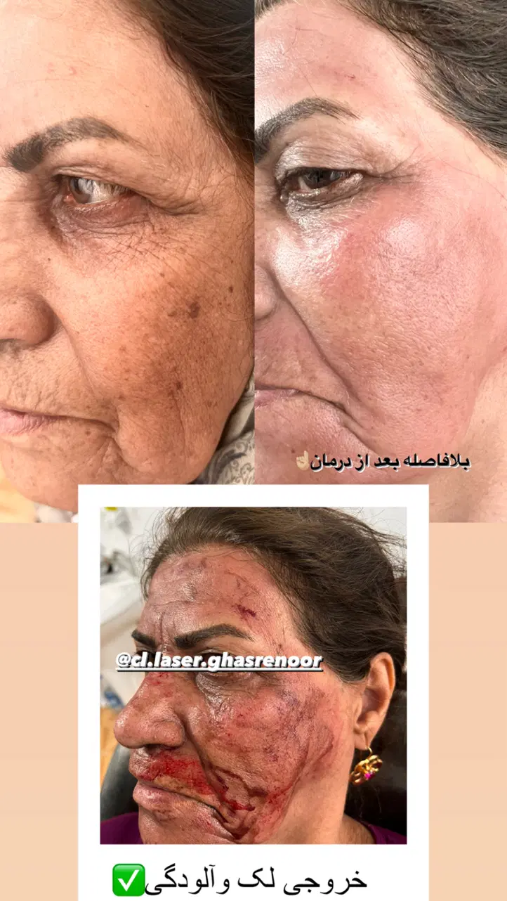درمان تخصصی لک و هایفو جشنواره تخفیف 50% در شیراز، ملاصدرا